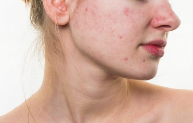 redness acne scar